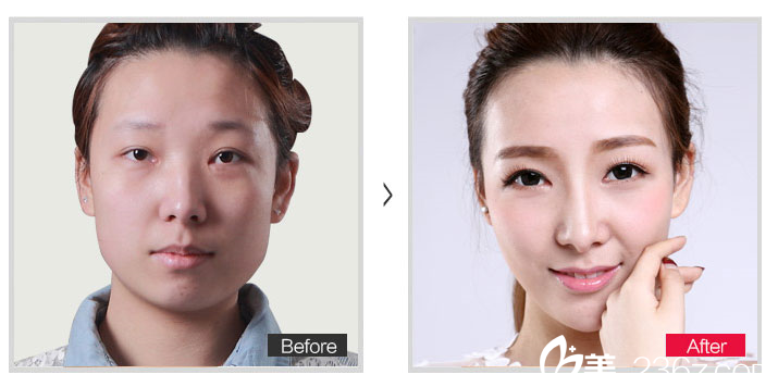 吳玉家醫(yī)生術(shù)后效果圖