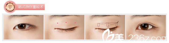 <!--<i data=20240703-sp></i>-->整形醫(yī)院韓式三點法