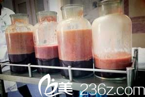 太原歐美蓮大腿吸脂吸出脂肪量