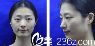 廈門歐菲注射玻尿酸前 廈門歐菲注射玻尿酸前