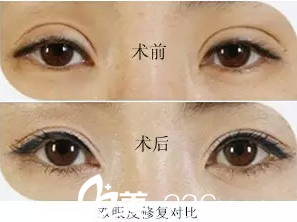 雙眼皮過(guò)寬