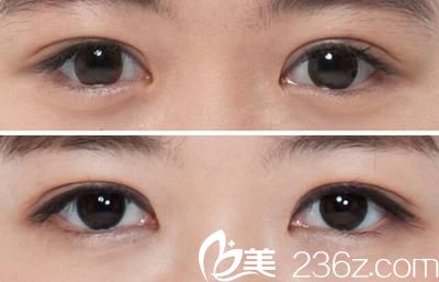 雙眼皮弧度不佳