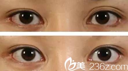 雙眼皮消失(多重折、不對(duì)稱)