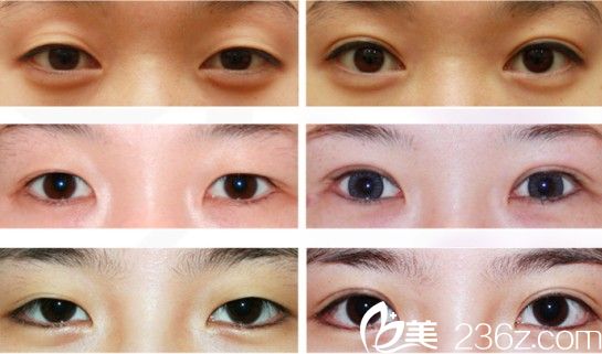 清潭割雙眼皮案例