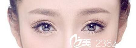 雙眼皮效果圖