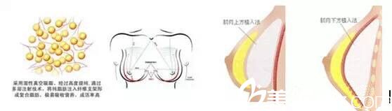 自體脂肪隆胸的手術(shù)誤區(qū)