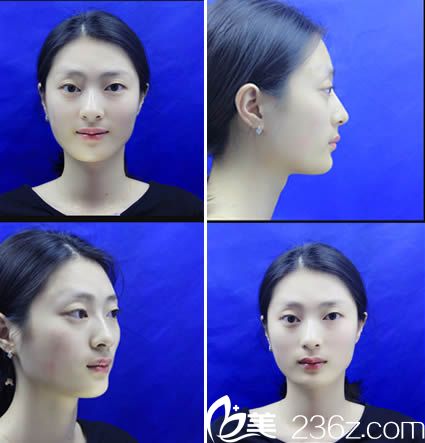 分享我找廈門歐菲注射玻尿酸隆鼻和豐太陽穴的恢復(fù)效果