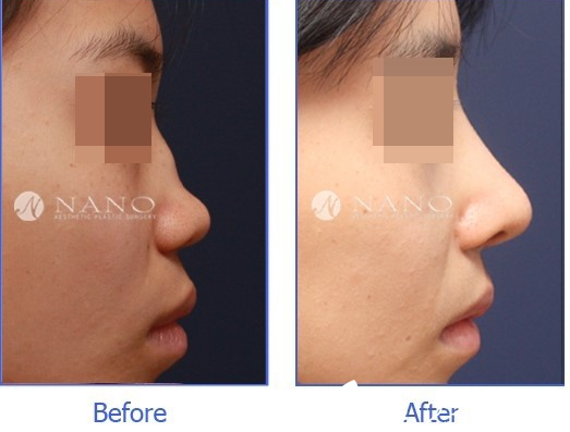 韓國(guó)Nano整形外科案例 韓國(guó)Nano整形外科案例