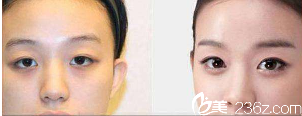 韓國(guó)Nano整形外科案例 韓國(guó)Nano整形外科案例