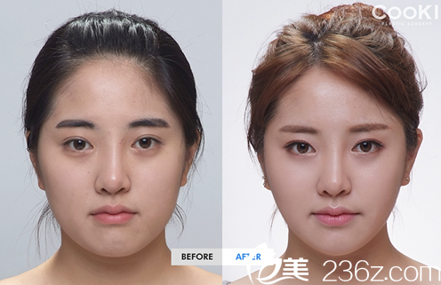 分享我在韓國cookie醫(yī)院做輪廓手術(shù)三個月的恢復(fù)日記