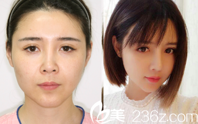 分享我在韓國cookie醫(yī)院做輪廓手術(shù)三個月的恢復(fù)日記