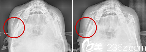 分享我在韓國cookie醫(yī)院做輪廓手術(shù)三個月的恢復(fù)日記