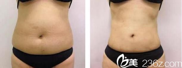 韓國(guó)wiz&美整形外科真人案例1 韓國(guó)wiz&美整形外科真人案例1