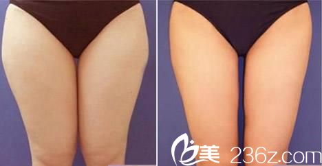 韓國wiz&美整形外科徐昇源吸脂手術效果好不好？激光溶脂真人案例