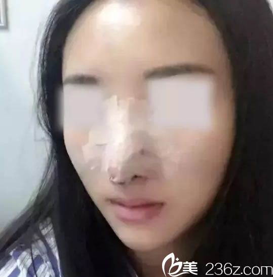 鼻綜合整形手術(shù)第1天恢復(fù)期