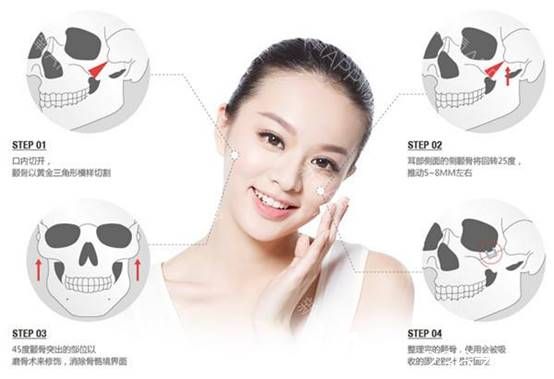 邊圣洙院長分享手術過程 邊圣洙院長分享手術過程