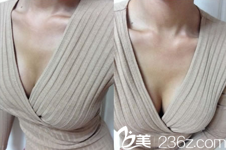 崔圭鎮(zhèn)院長隆胸對比圖 崔圭鎮(zhèn)院長隆胸對比圖