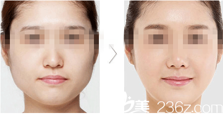 瘦臉除皺瘦臉前后對比圖