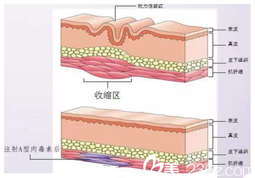 瘦臉除皺注射層面