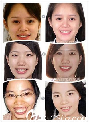 廈門李博醫(yī)生牙齒整形<span style= 廈門李博醫(yī)生牙齒整形<span style=