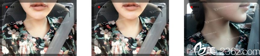 韓國(guó)女神整形醫(yī)院做微笑唇真人案例