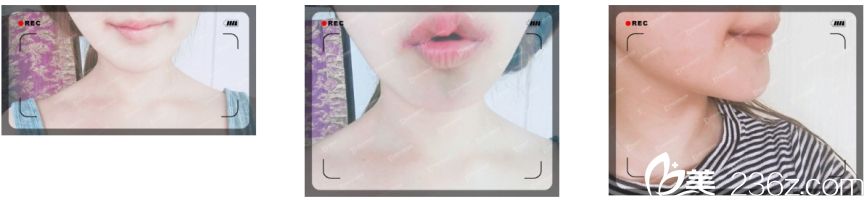 嘴角上揚(yáng)術(shù)后第六天崔宇景院長(zhǎng)嘴角上揚(yáng)真人案例