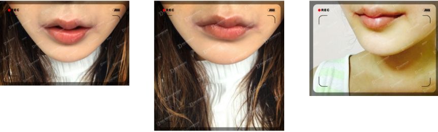 微笑唇術(shù)后20天崔宇景