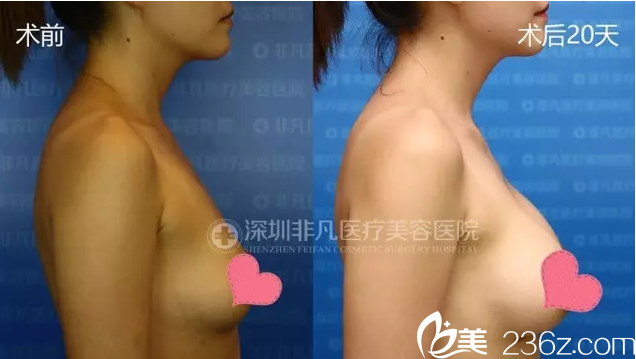 找深圳非凡楊偉杰做的隆胸20天側(cè)面效果 找深圳非凡楊偉杰做的隆胸20天側(cè)面效果