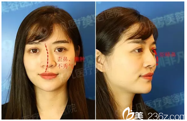 隆鼻術(shù)前照片 隆鼻術(shù)前照片