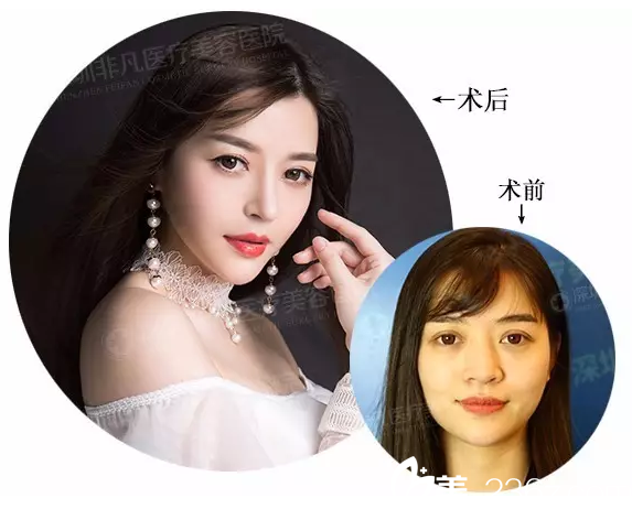深圳非凡梅夠明隆鼻案例對(duì)比圖 深圳非凡梅夠明隆鼻案例對(duì)比圖