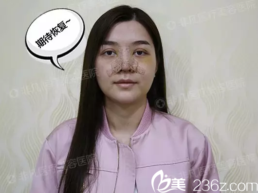 找深圳非凡梅夠明院長(zhǎng)做完隆鼻即刻效果 找深圳非凡梅夠明院長(zhǎng)做完隆鼻即刻效果