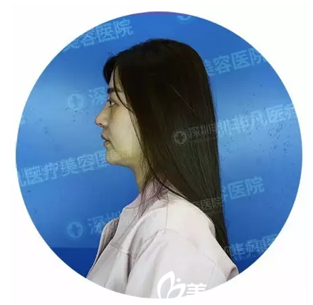 剛在深圳非凡做完鼻部拆線 剛在深圳非凡做完鼻部拆線