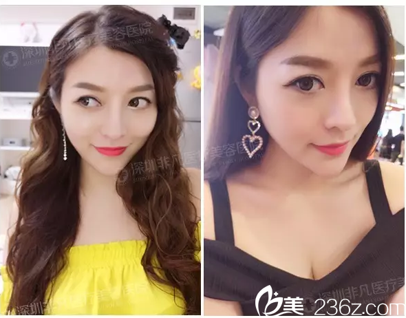 隆鼻術(shù)后1個(gè)月自拍 隆鼻術(shù)后1個(gè)月自拍