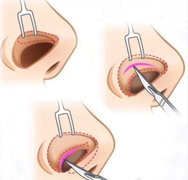 非切開式隆鼻手術(shù)封閉式隆鼻方法 非切開式隆鼻手術(shù)封閉式隆鼻方法