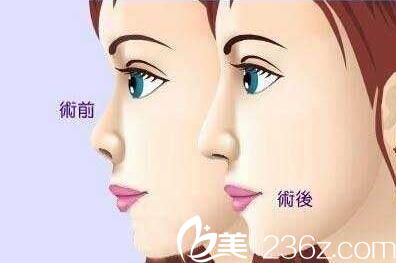 韓國(guó)格林整形醫(yī)院自體脂肪隆鼻 韓國(guó)格林整形醫(yī)院自體脂肪隆鼻