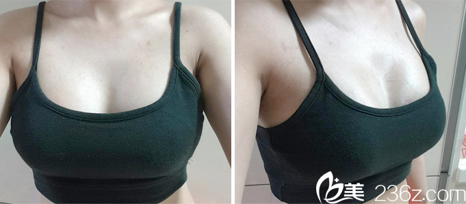 世大特START醫(yī)院胸部整形案例術(shù)后2周恢復(fù)