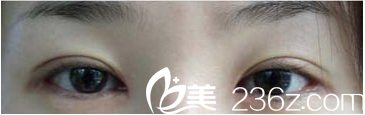 看我在La Foret整形外科做的雙眼皮修復(fù)，李斗陽(yáng)院長(zhǎng)案例