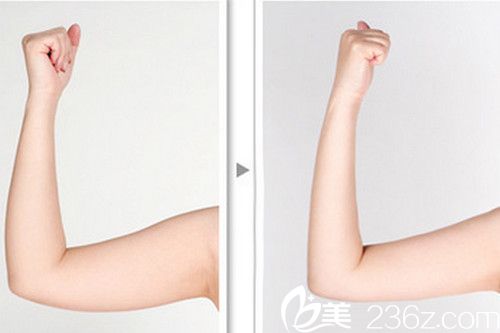 韓國眼鼻美人整形外科手臂吸脂對比 韓國眼鼻美人整形外科手臂吸脂對比