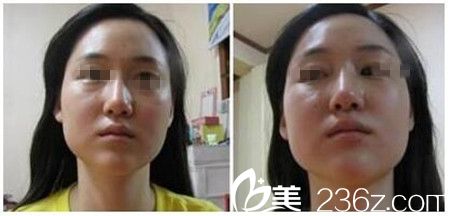 駐馬店美林苑改臉型案例