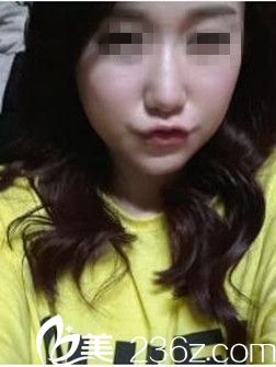 駐馬店美林苑改臉型術后9周照