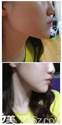 駐馬店美林苑改臉型術后10周照