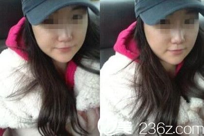 駐馬店美林苑改臉型術后