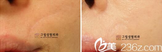 韓國格林整形醫(yī)院真人案例1 韓國格林整形醫(yī)院真人案例1