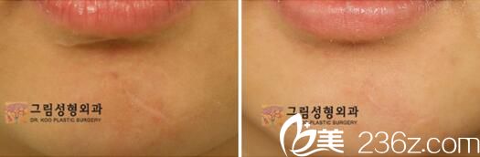 韓國(guó)格林整形金亨俊去疤痕效果好不好？激光祛疤真人案例