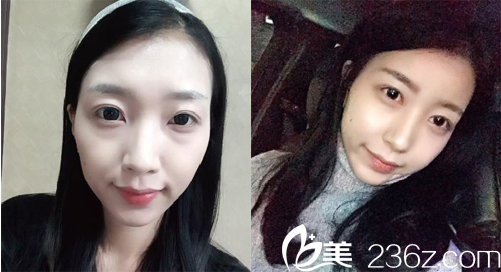 徐東皖院長(zhǎng)面部自體脂肪填充案例對(duì)比 徐東皖院長(zhǎng)面部自體脂肪填充案例對(duì)比