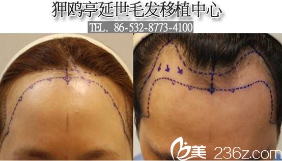 韓國(guó)狎鷗亭延世醫(yī)院毛發(fā)移植發(fā)際線(xiàn)移植 韓國(guó)狎鷗亭延世醫(yī)院毛發(fā)移植發(fā)際線(xiàn)移植