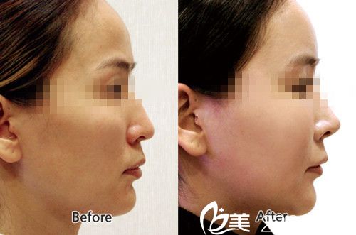 韓國眼鼻美人整形外科好不好？隆鼻真人案例
