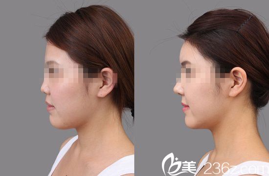 金基出院長隆鼻前后對比圖 金基出院長隆鼻前后對比圖