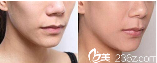 ISTAR整形外科案例 ISTAR整形外科案例