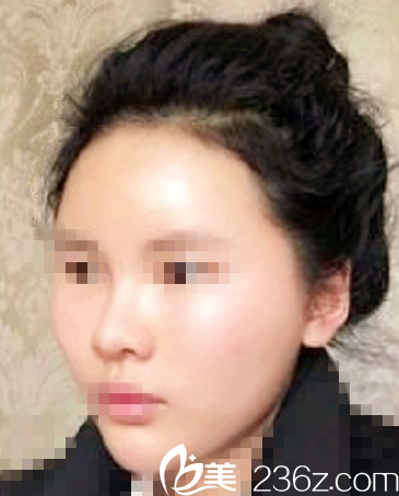 延世plus醫(yī)院自體脂肪填充面部術(shù)后第三天